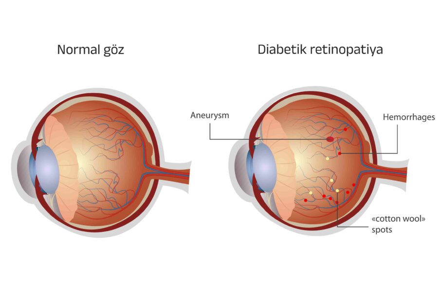 diabetik retinopatiya
